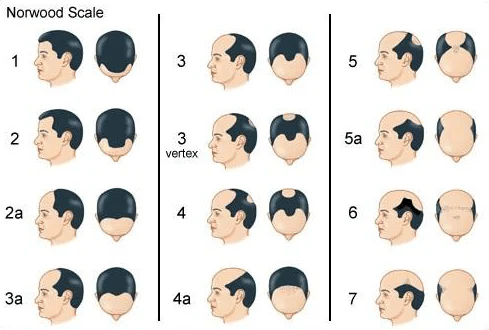 behandelingen-norwood-scale Haarverlies proces bij vrouwen opgedeeld in type I en II