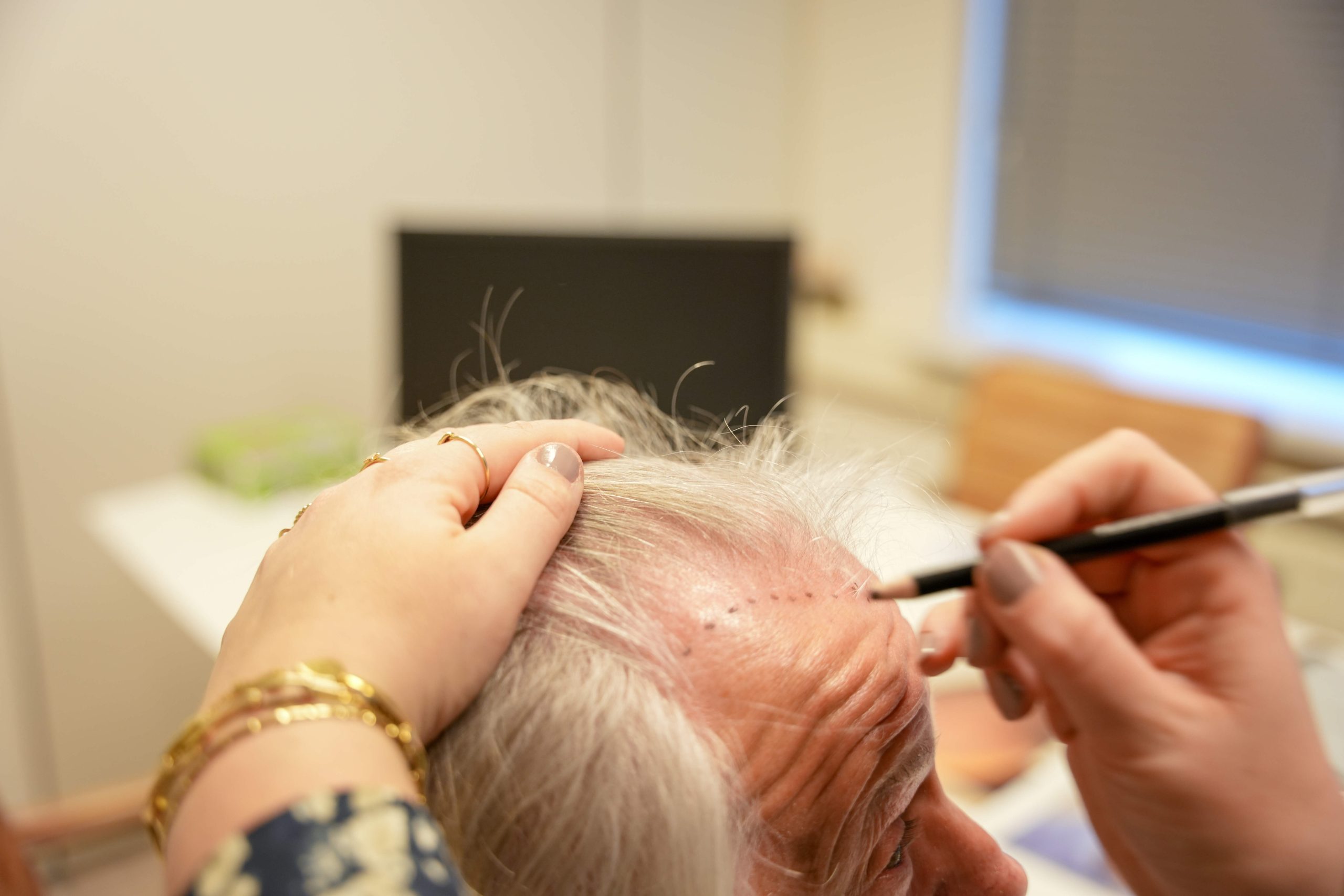 behandelingen-wat-is-een-haartransplantatie Wat is een haartransplantatie?
