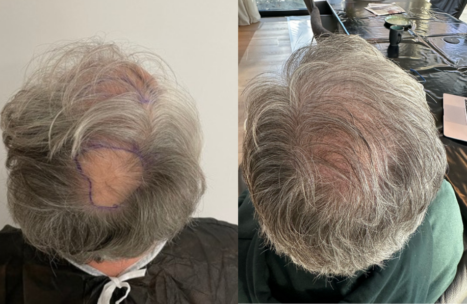 Before and after photo hair transplant