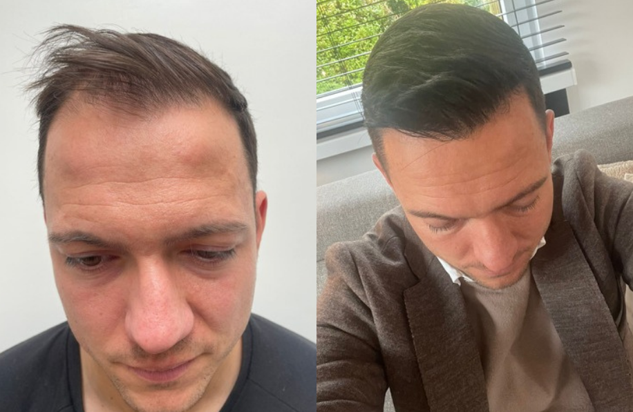 Before and after photo hair transplant man