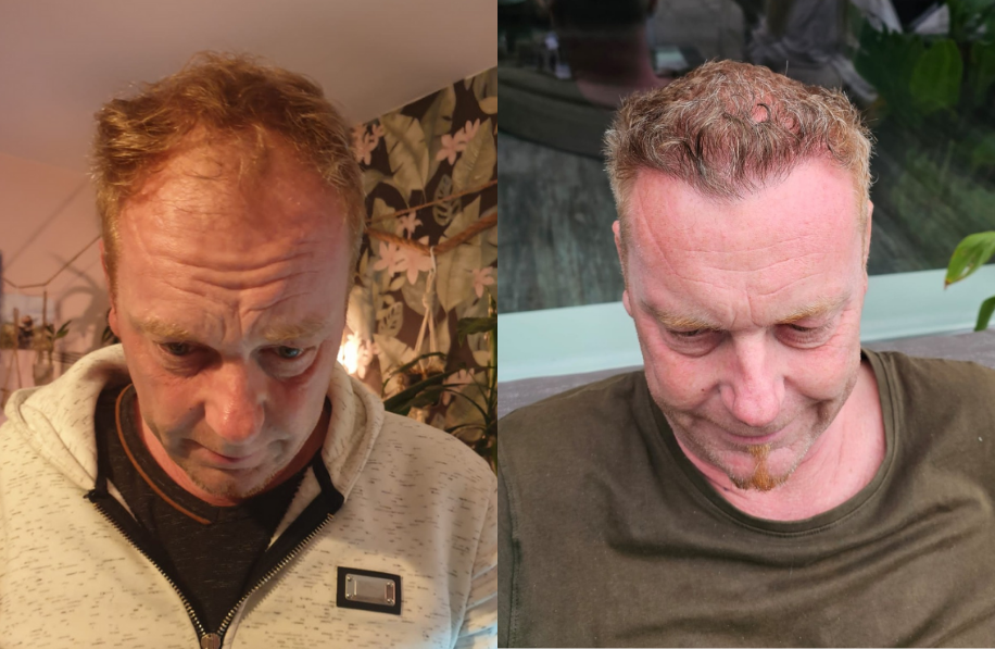 Before and after photo hair transplant man